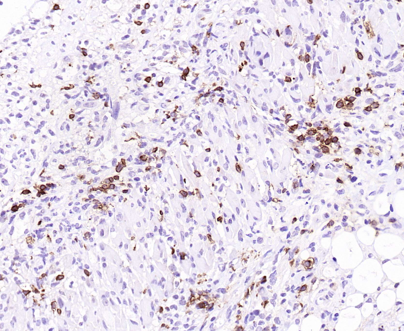 颗粒细胞瘤免疫组化图片